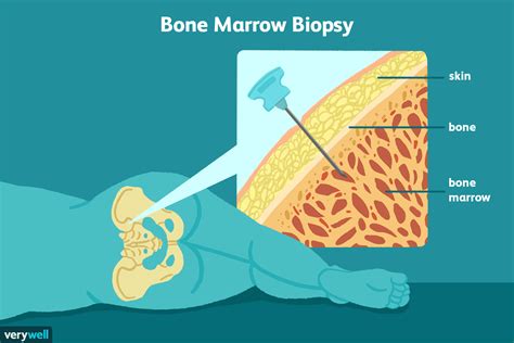 reasons for a bone marrow test.